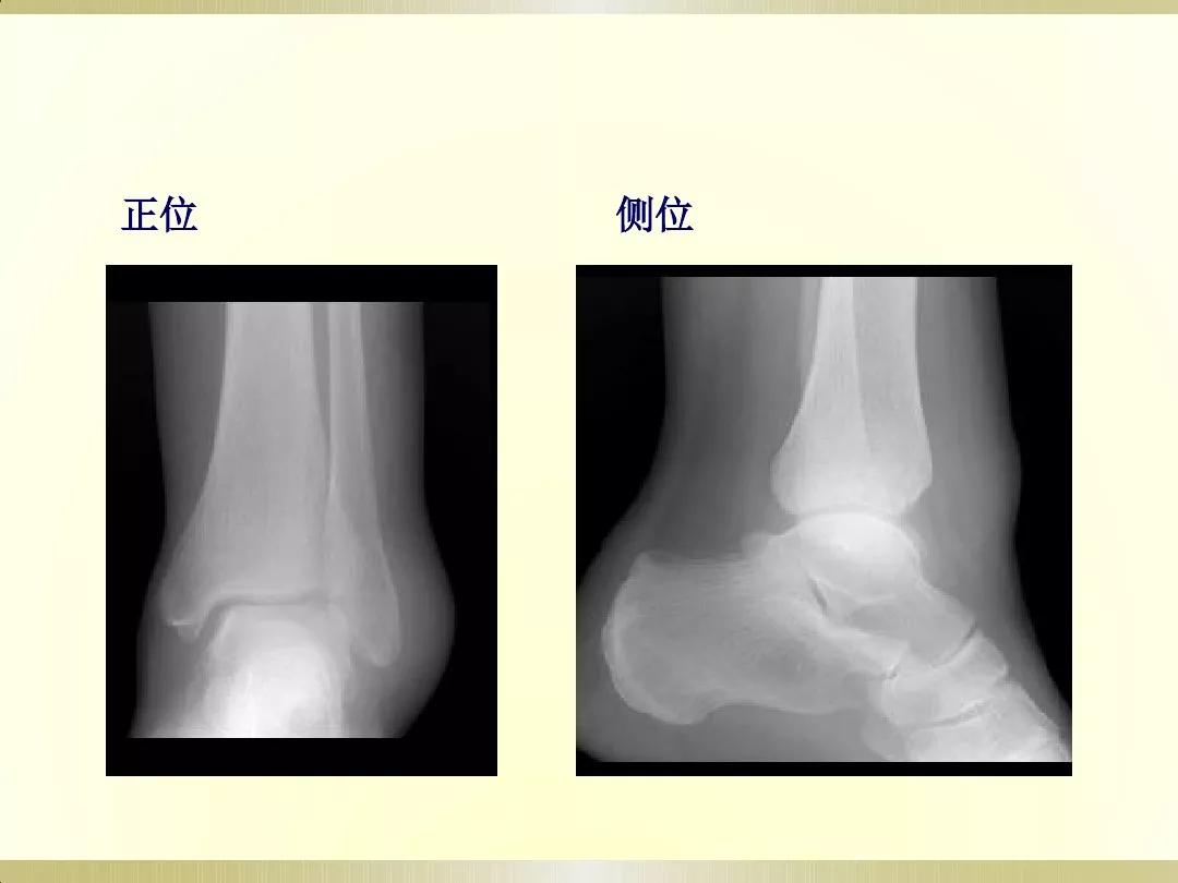 骨科x光片读片技巧,放射科骨科读片教程