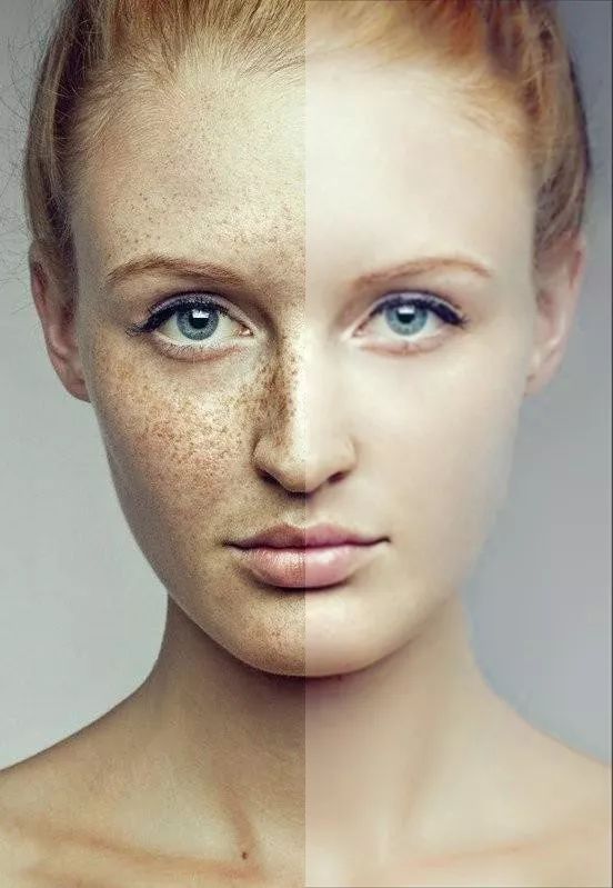 祛除脸部雀斑最有效的方法,有什么日常方法可以去除脸上雀斑