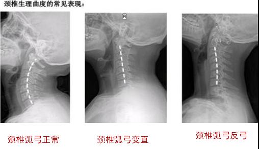 医生说“颈椎曲度变直或者反弓”该怎么办