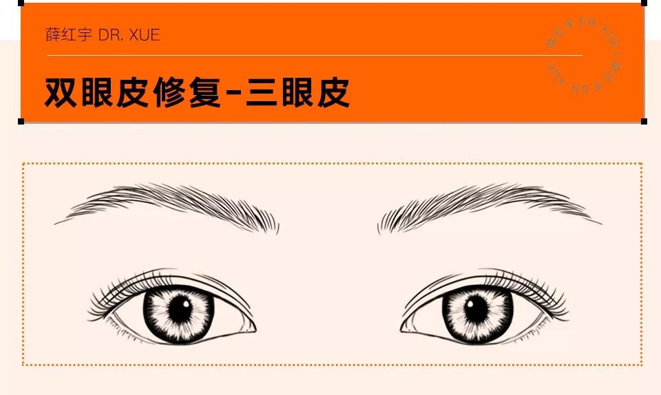 双眼皮整形修复,潘贰双眼皮修复