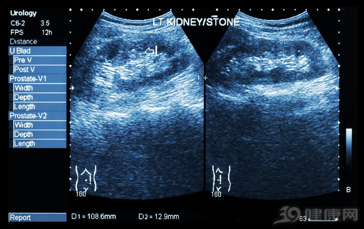 体检查出肾结石该怎么办,体检出肾结石怎么去医院问诊