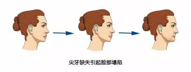 小孩长了虎齿怎么办,小孩长老虎的牙可以矫正吗