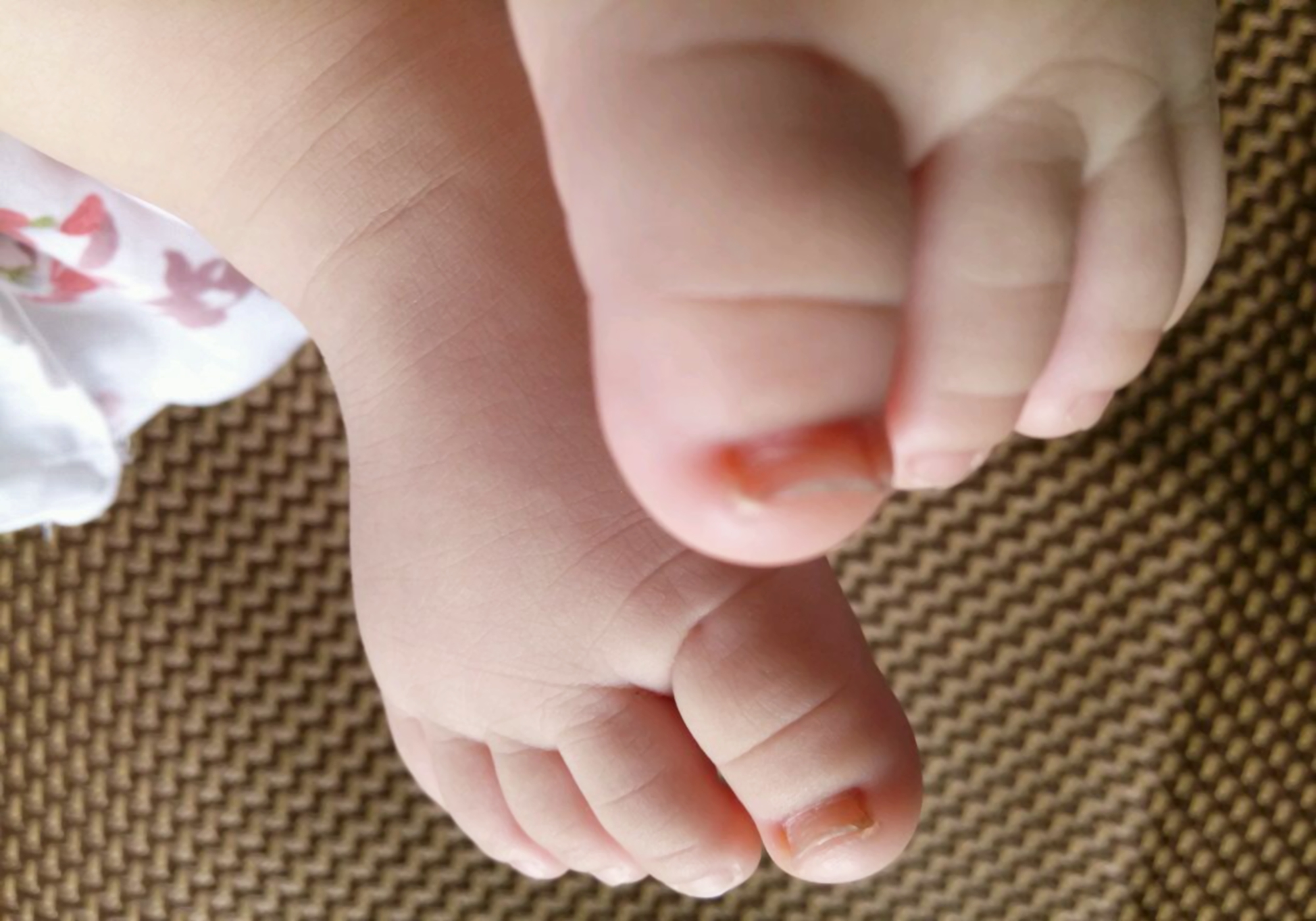 五岁儿童穿高跟鞋脚变形,五岁女孩脚趾变形