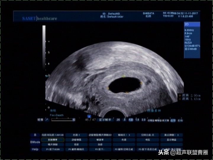 内见卵黄囊,卵黄囊肿瘤
