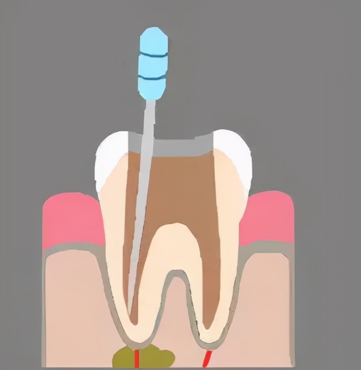 根管治疗怎样才要做,根管治疗的药不小心弄掉了