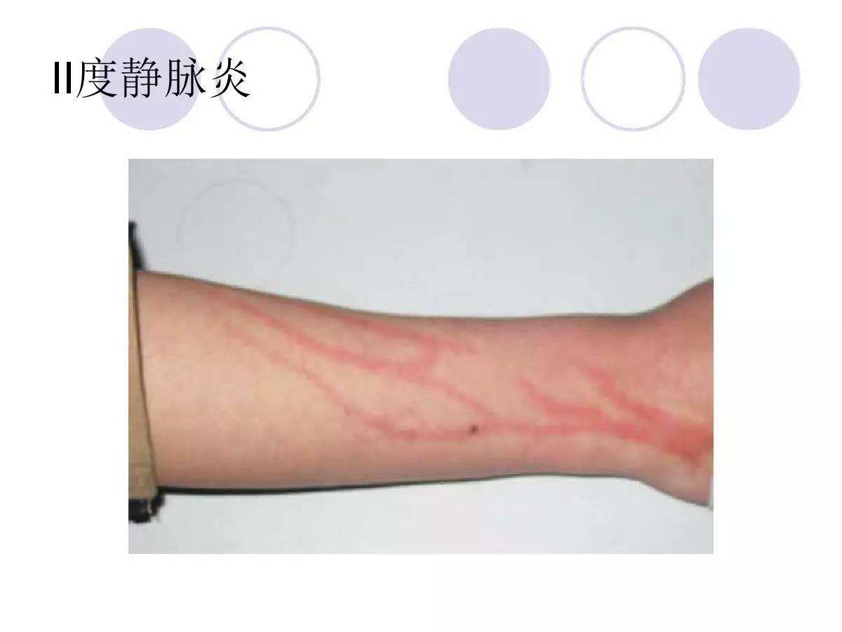 医学生急救知识点,提前学习一下输液反应的急救措施