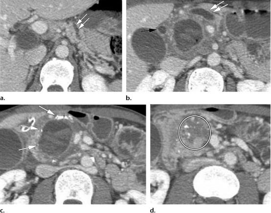 急性胰腺炎和慢性胰腺有什么症状,胰腺炎合并胰腺肿物