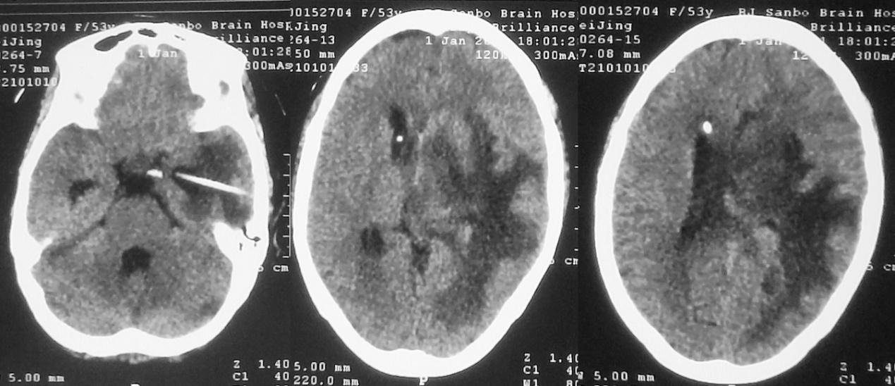脑脓肿合并脑膜炎需要手术吗,脑脓肿进入左侧脑室严重吗