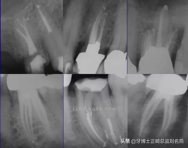 根管治疗难点与解决方案,根管治疗牢固吗