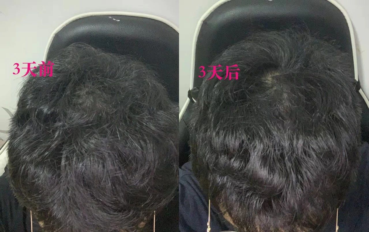 头发易出油头皮多怎么回事,头皮上有螨虫头发掉怎么办