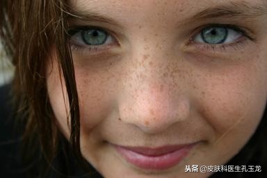 皮肤科常见疾病系列,雀斑属于什么皮肤病