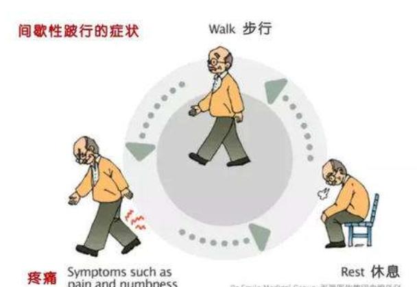 腰疼椎管狭窄压迫神经怎么治疗,腰疼椎管狭窄有什么办法