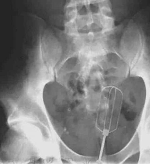 不作死就不会死,看看这些被人类搞进身体里的异物