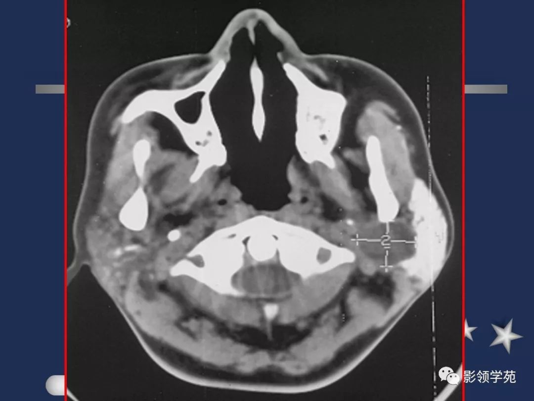 腮腺疾病影像学诊断,腮腺肿块影像诊断