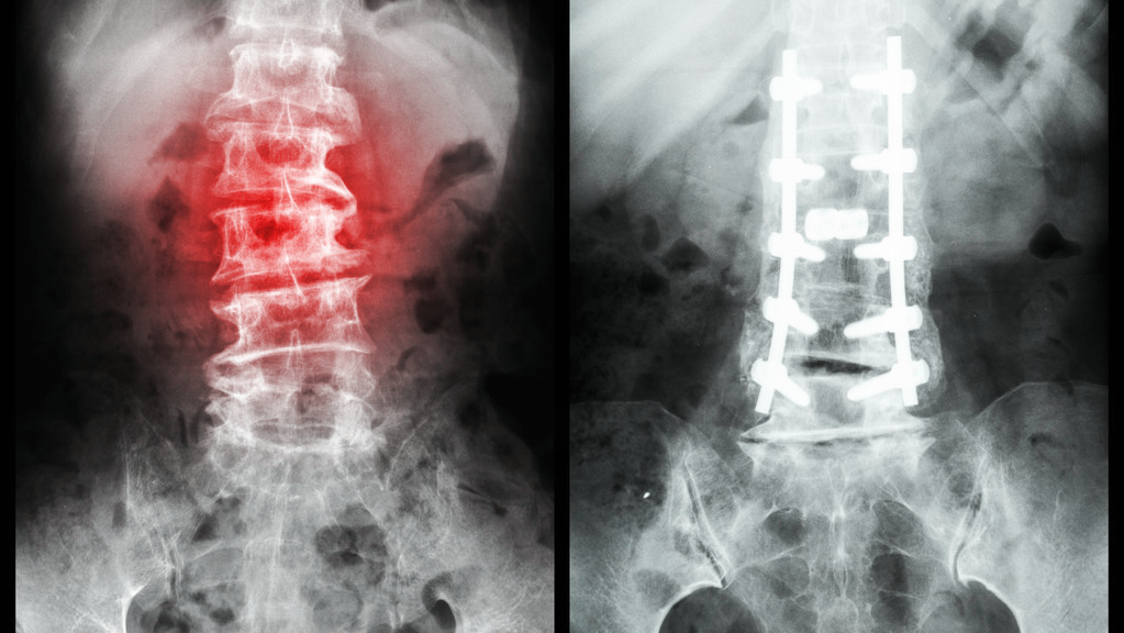 腰椎压缩性骨折保守100天能坐多久,腰椎骨折保守治疗100天可以弯腰吗