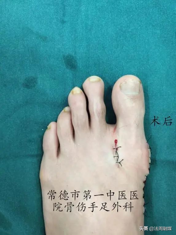 拇指长歪了?别慌!常德市第一中医医院专家帮您改“邪”归正