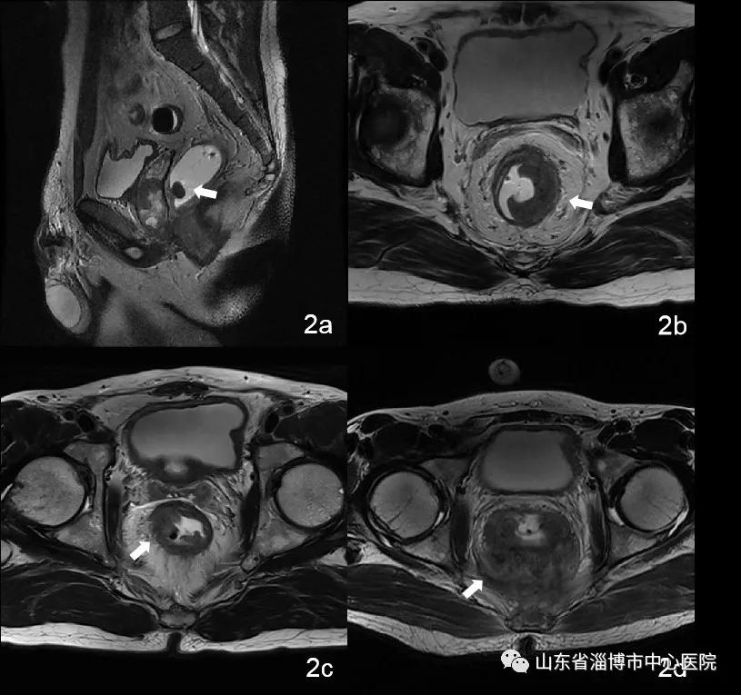 直肠指检不发现的病,直肠指检发现不了什么