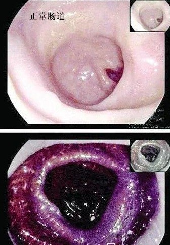 女子吃酵素惹出肝病,女子吃酵素梅