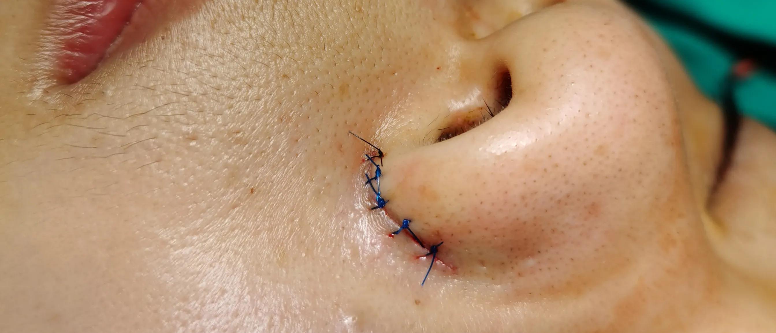 整形医生做面部美容视频,鼻头鼻翼缩小术的真实案例