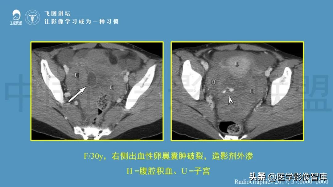 子宫解剖结构输卵管和卵巢位置,子宫附件ct影像学正常解剖表现
