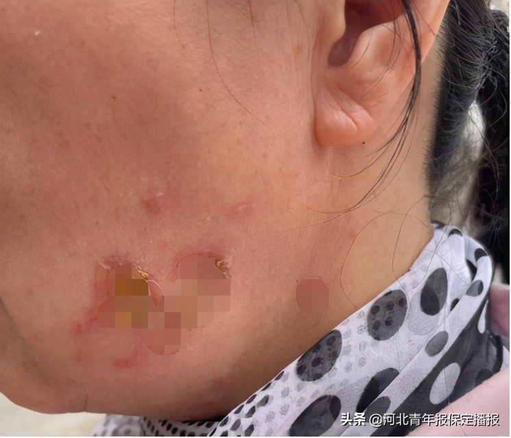 河北保定热玛吉,保定热玛吉事件