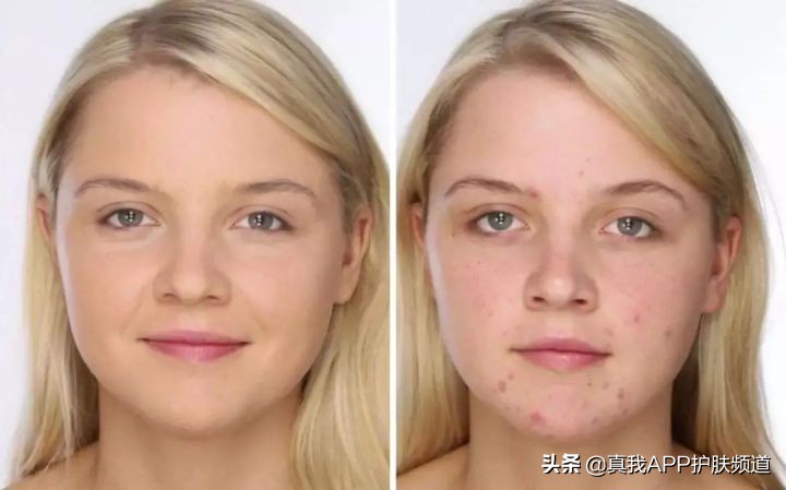 怎么去掉背上的痘痘,去掉脸上的痘痘最好办法