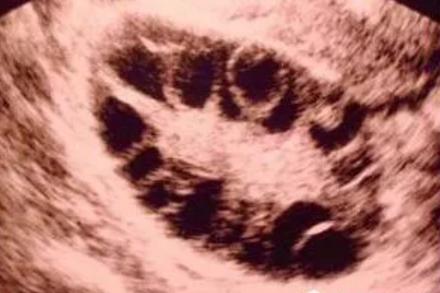 多囊卵巢饮食食谱大全,多囊卵巢综合症是什么