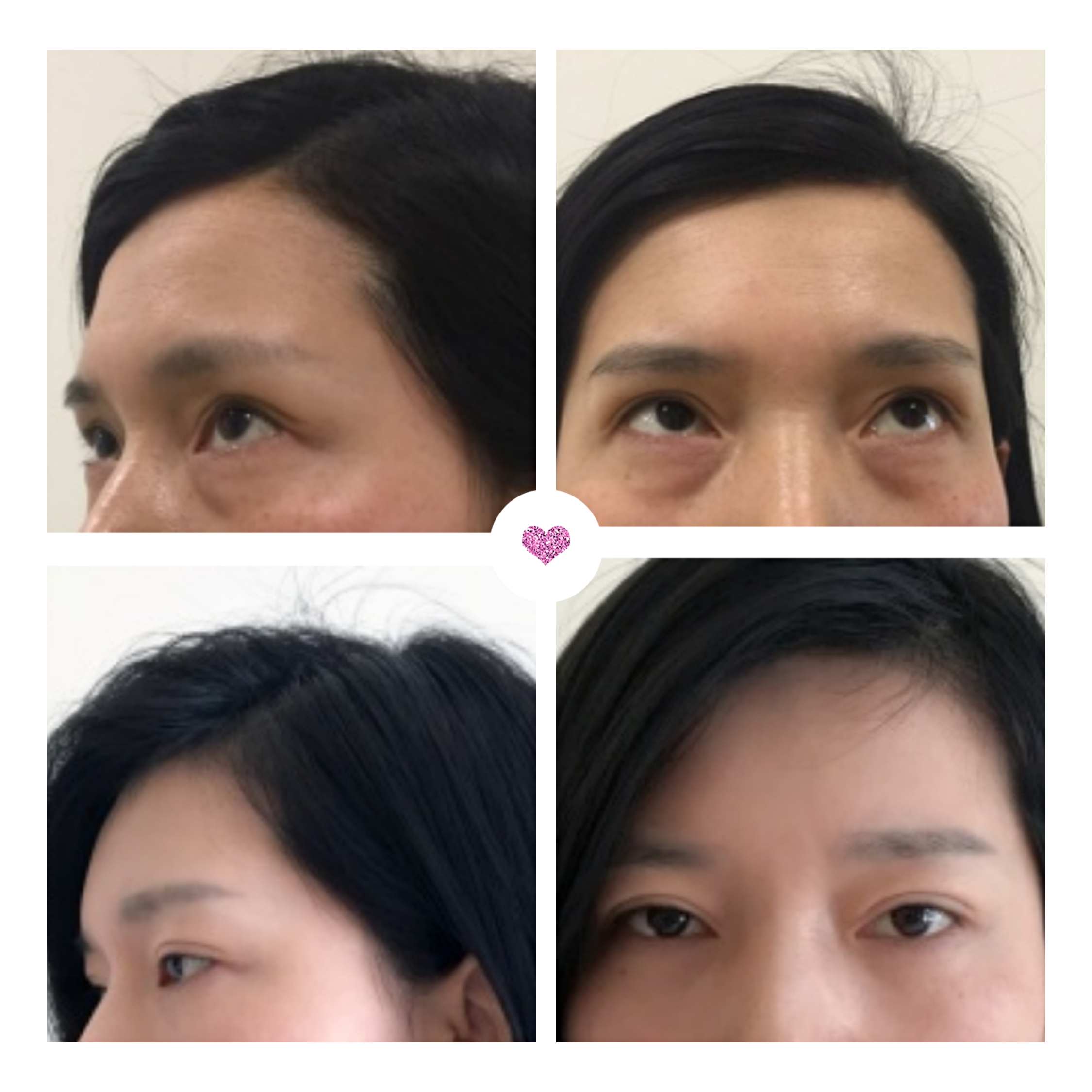 鱼尾纹眼袋怎么去除最有效,眼袋鱼尾纹怎么去除简单方法