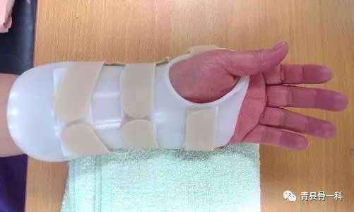 腕舟骨骨折不错位能自愈吗,手部腕舟骨骨折为什么不易愈合