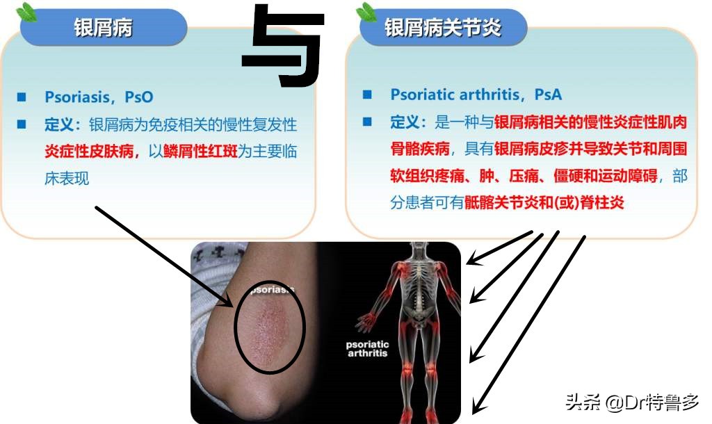 牛皮癣导致关节肿痛如何止痛,得了牛皮癣能治愈吗