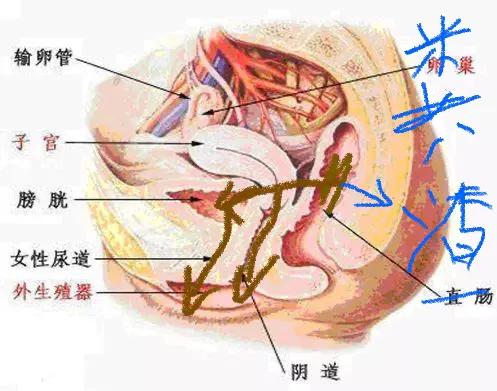 当女人膀胱、宫颈、直肠被癌症强行“打通”以后会是什么后果?