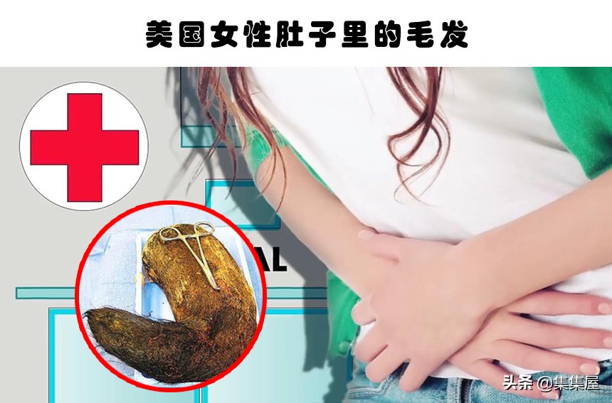 在人体内发现的6个难以用常理解释的物体