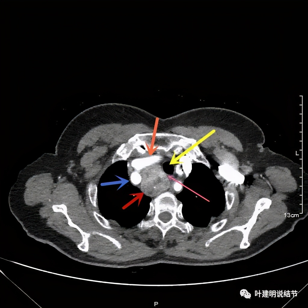 胸部高分辨ct检查注意事项,胸部ct扫描有没有危害