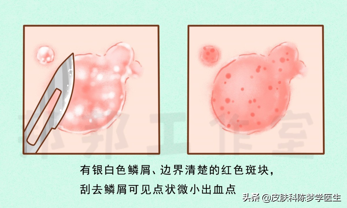 红色斑块脱屑一定是牛皮癣吗,皮肤上有癣起皮颜色呈褐色