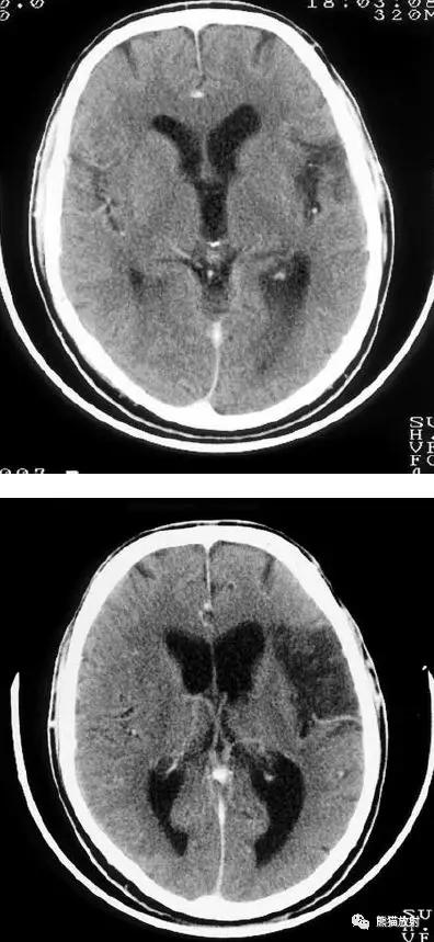 脑梗死丨演变、血供区域分布、CT表现