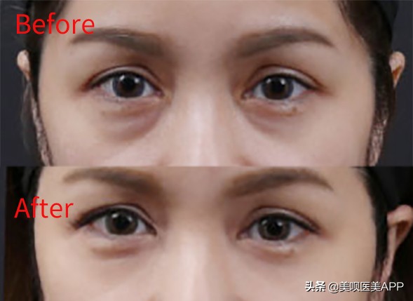 祛眼袋手术后多久恢复自然,西安哪家医院祛眼袋手术做的最好