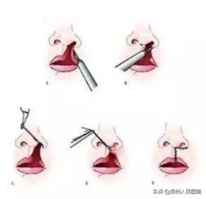 严重唇腭裂修复效果,唇裂修复对比照片