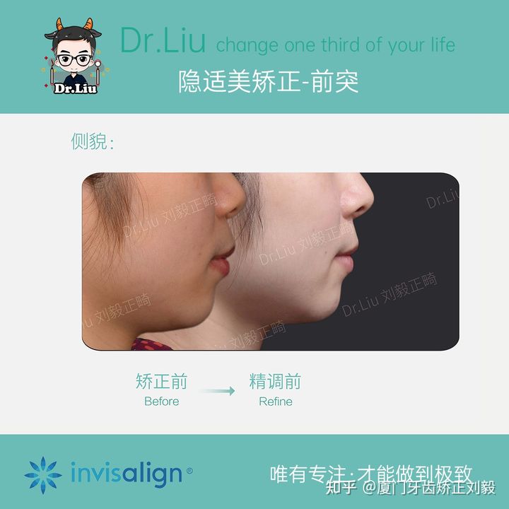 牙齿矫正厦门口腔医院,厦门隐形龅牙矫正优惠