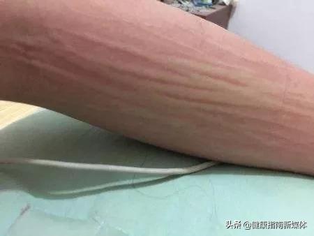 皮肤瘙痒症如何防治