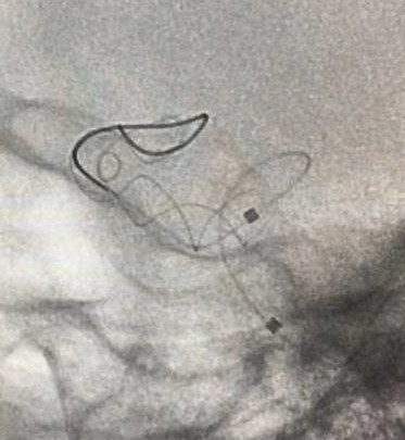 Tubridge®治疗多发性动脉瘤