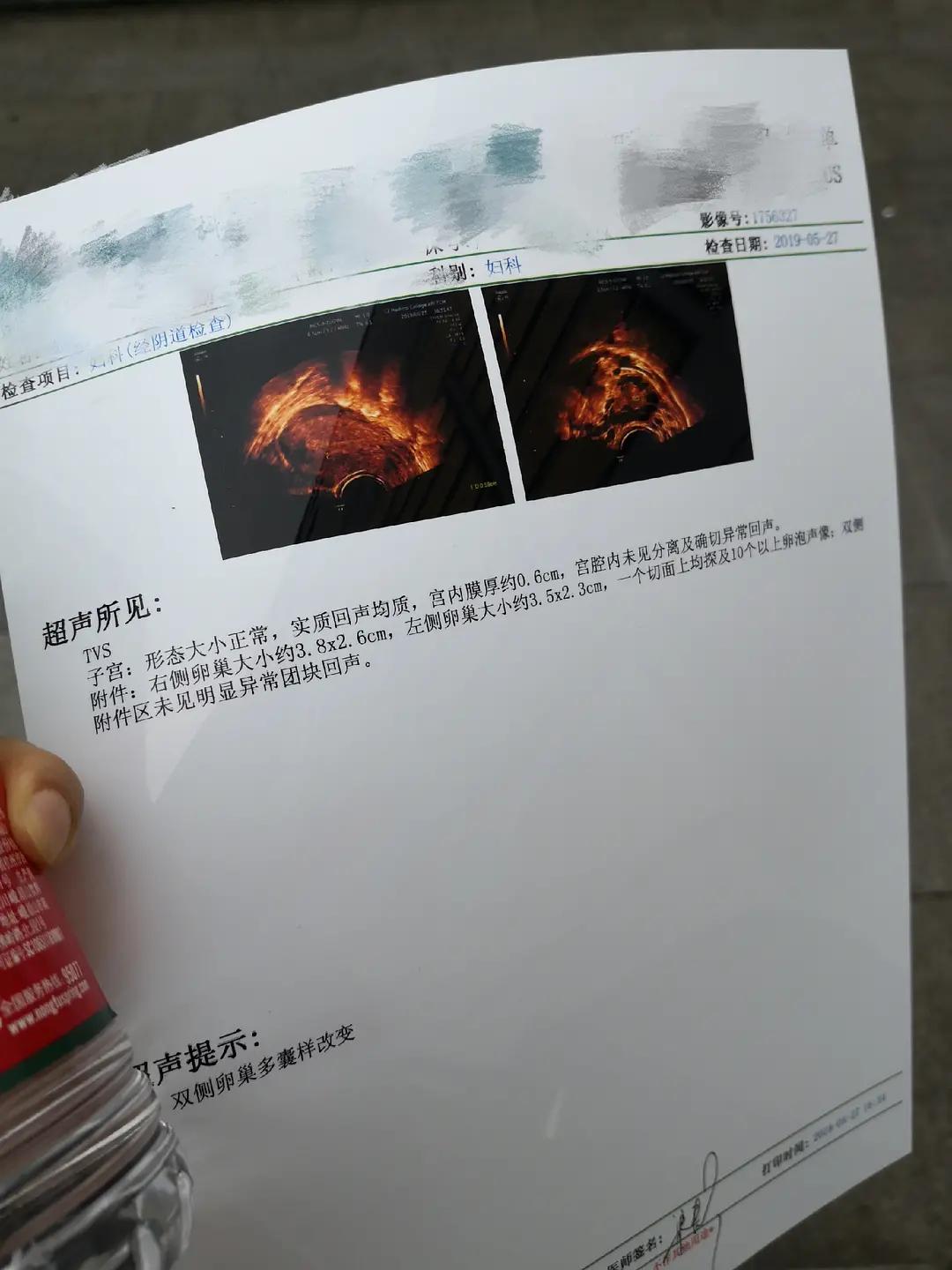 hpv58治疗期间注意事项,hpv58一级病变转阴历程