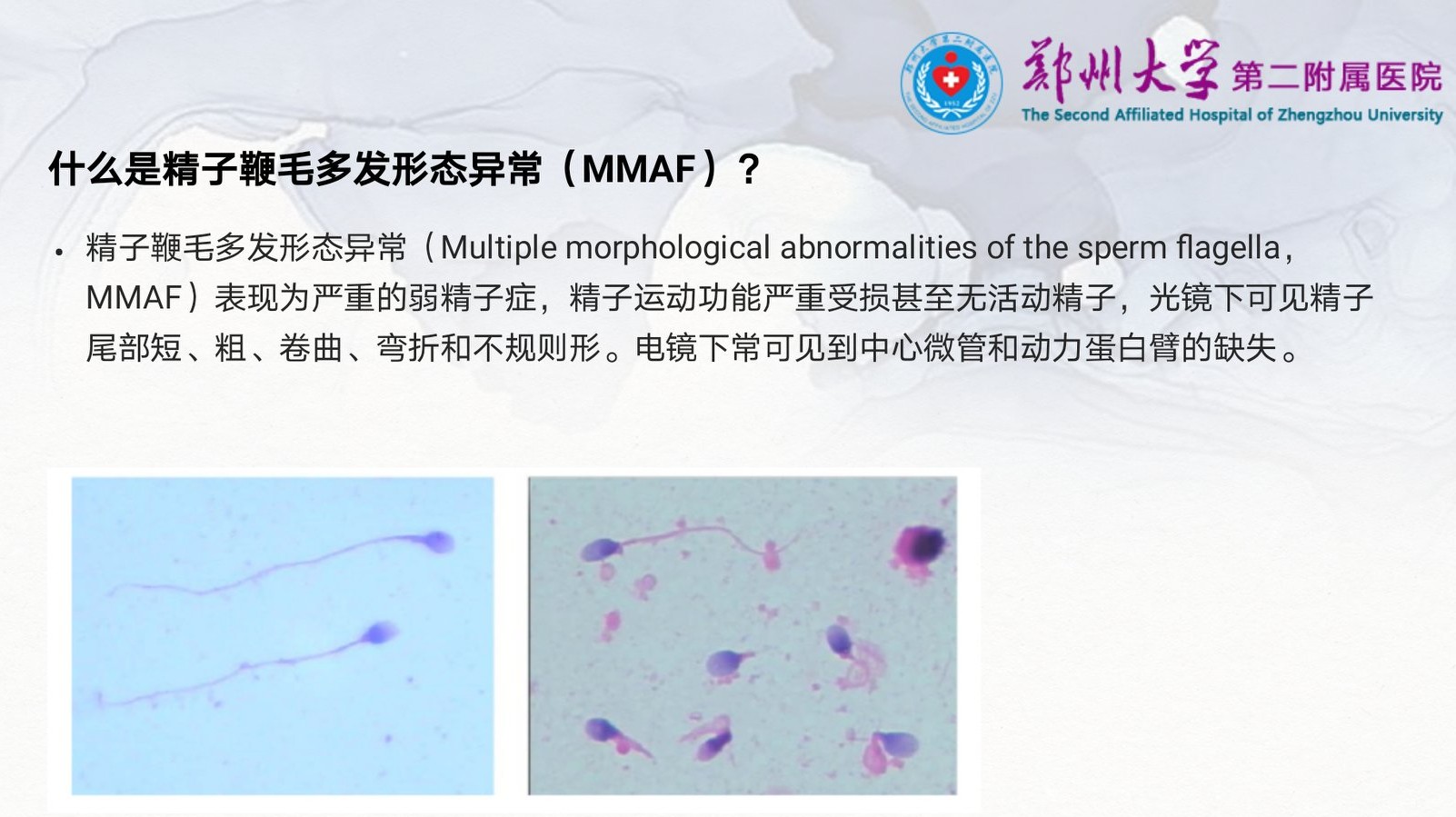 严重弱精症原因,重度少精弱精症可能的原因