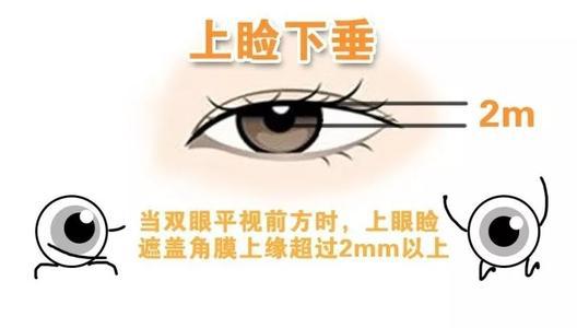 小儿推拿治疗上眼睑下垂,儿童推拿眼睛的正确方法