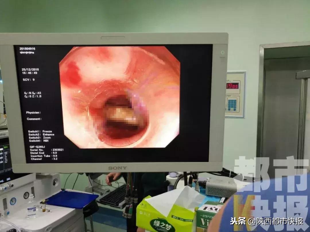 孕妇不小心吞了一个红枣核要紧吗,孕妇不小心吞了一个枣核