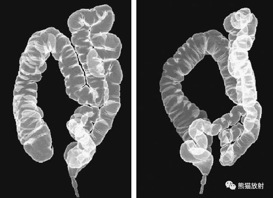 腹部影像图片大全,乙状直肠疼痛位置图片
