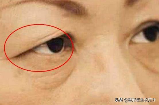 上眼皮松弛预示十种疾病,上眼皮松弛显凶