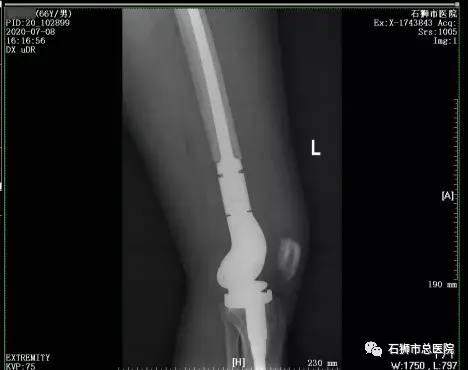 石狮市骨科医院,石狮市总医院骨科多少钱