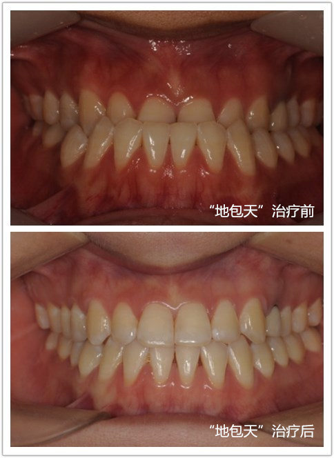 牙齿矫正地包天矫正器图片,牙齿矫治器地包天