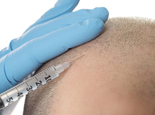 植发拆东墙补西墙有什么用,植发是拆东墙补西墙吗