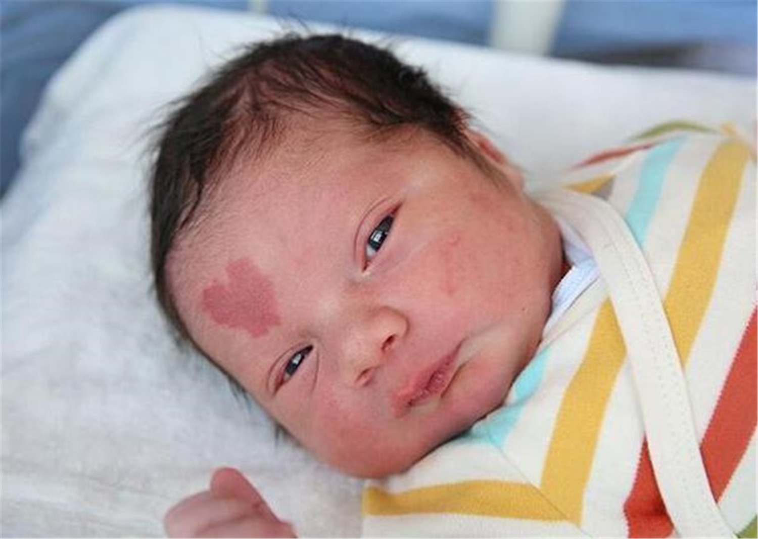 胎儿长胎记是怎么造成的,胎儿容易长胎记的原因是什么